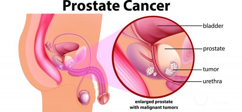 protein-rich-foods-increase-prostate-cancer-risk