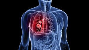 Lung CANCER